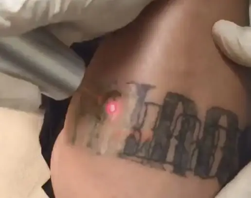 tattoo removal rocklin ca