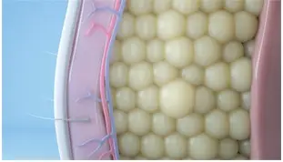 CoolSculpting® Elite focuses on eliminating stubborn fat