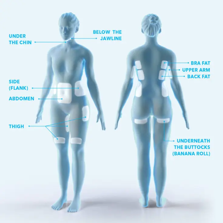 CoolSculpting® Elite diagram showing all the areas that the treatment can be used
