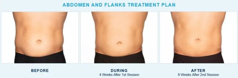 CoolSculpting® Elite abdomen and flank treatment before and after for a male patient