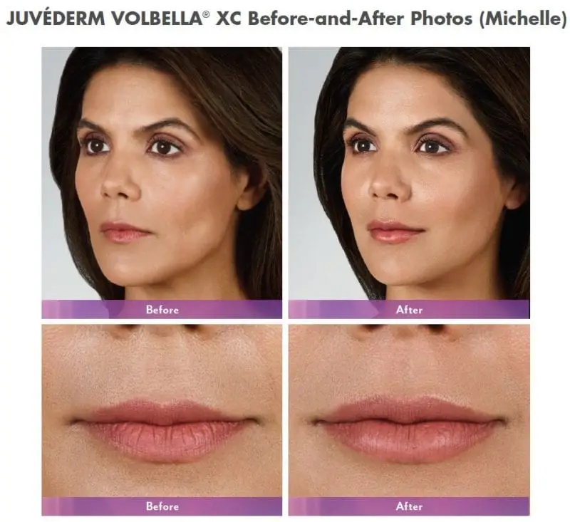 Juvederm Volbella® XC Lip Injection Gel Before and After Full face and focus on lips