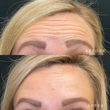 forehead wrinkles disappear with Botox filler from La Bell Vita Medi Spa Rocklin