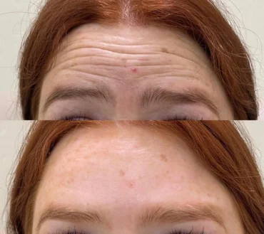 botox filler reduces forehead wrinkles - La Bell Vita Medi Spa Rocklin