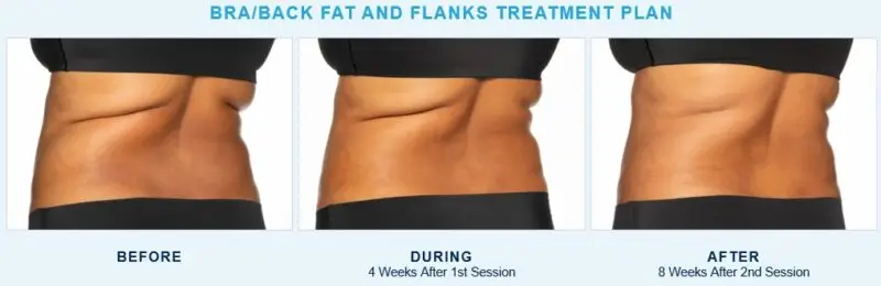CoolSculpting® Elite back and bra fat treatment