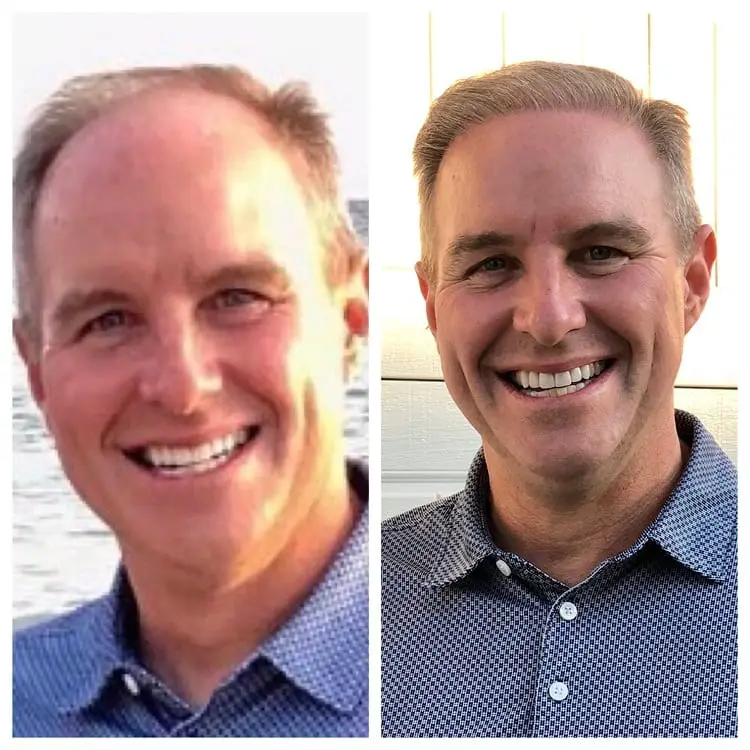 Brent after 8 months of Neograft hair transplants