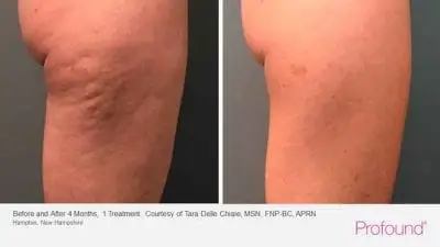 Profound treatment on but - side view- before and after 4 months