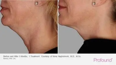 Profound treatment on neck and chin - before and after 3 months