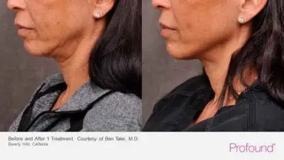 Profound treatment on neck and chin - before and just 1 treatment