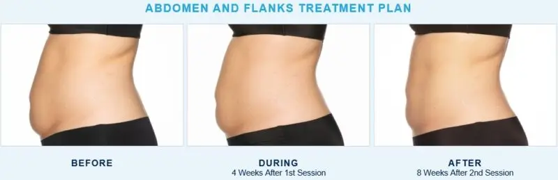 CoolSculpting® Elite abdomen and flank treatment before and after for a female patient