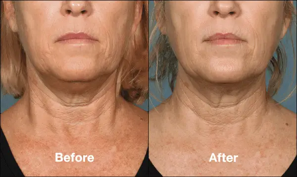 Kybella Before ad After Front View