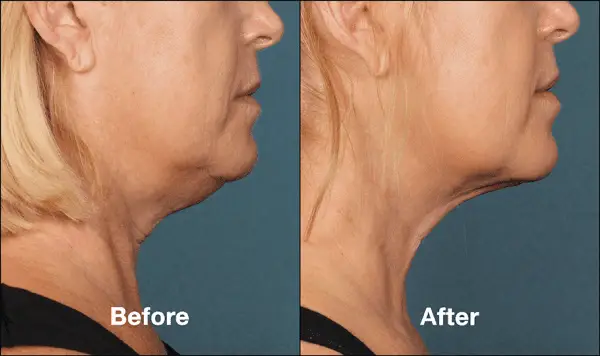 Kybella Before ad After Side View