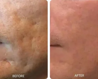 laser resurfacing before and after photo - La Bella Vita Medi Spa patient