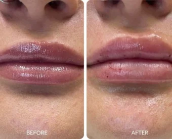 lip filler before and after photo - La Bella Vita Medi Spa patient