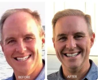 La Bella Vita Medi Spa hair replacement patient after 8 months of NeoGraft services