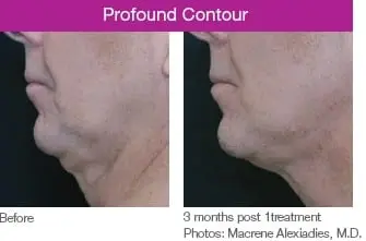 Profound treatment on neck and chin on male patient - before and after 3 months
