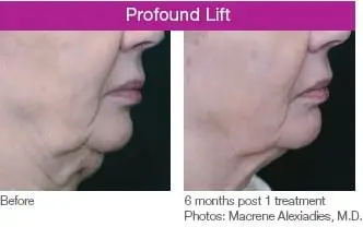 Profound treatment on neck and chin on elderly woman - before and after 6 months