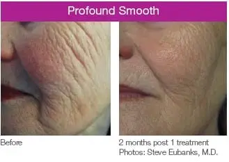 Profound skin smoothing treatment - before and after 2 months