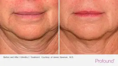 Profound treatment on sagging neck - before and after 3 months