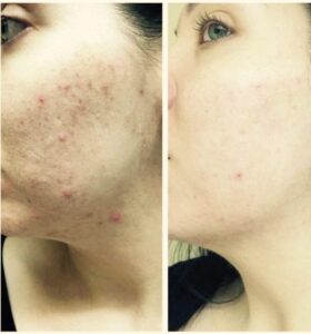 sublative treatment for acne scarring