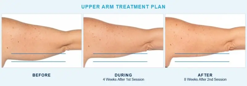upper arm treatment by CoolSculpting elite - La Bella Vita Medi Spa