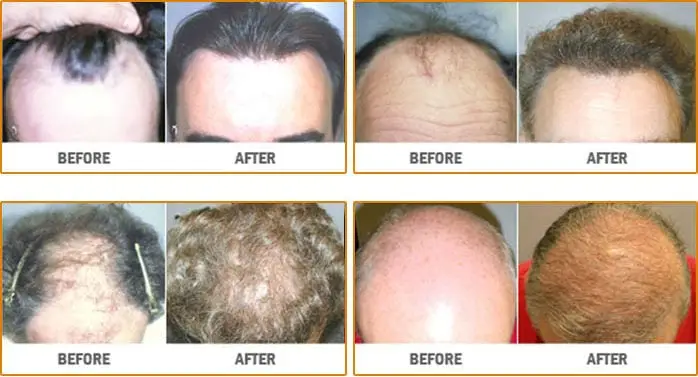 Neograft Hair Restoration Before and After photos of 4 men