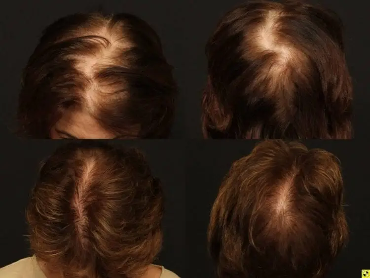 Before and after pictures of a women who received NeoGraft Hair restoration treatment: La Bella Vita Medi Sap