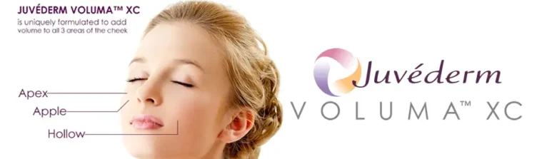 Juvederm Voluma XC adds volumes to your cheeks