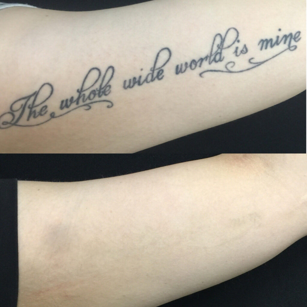 Before and after photo of laser tattoo removal results using PicoWay at La Bella Vita Medi Spa in Rocklin